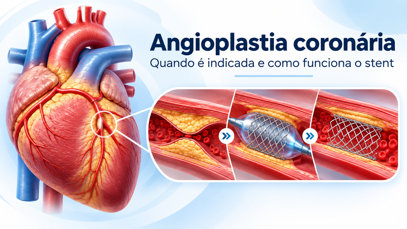 angioplastia